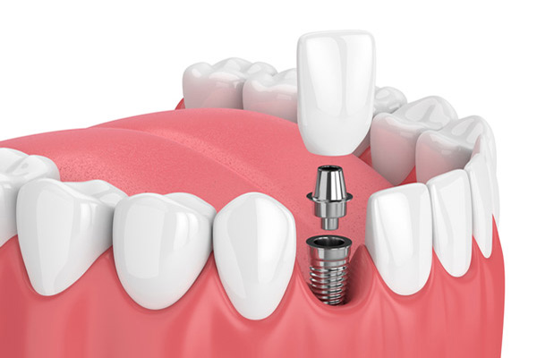 Dental Implants, Advanced Dental Care, Kathmandu, Nepal