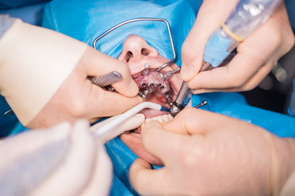 Oral Surgery, Advanced Dental Care, Kathmandu, Nepal