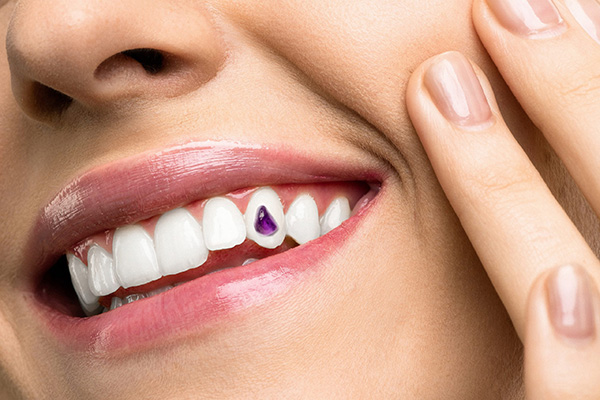 Tooth jewelry, Advanced Dental Care, Kathmandu, Nepal